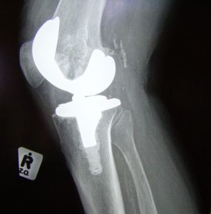 knee-replacement---side-view-1183622-m