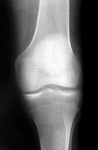 knee-x-ray-1-391480-m