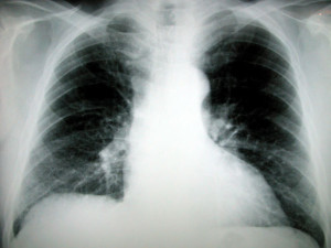 chestxray