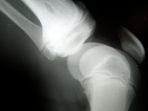 defective knee replacement